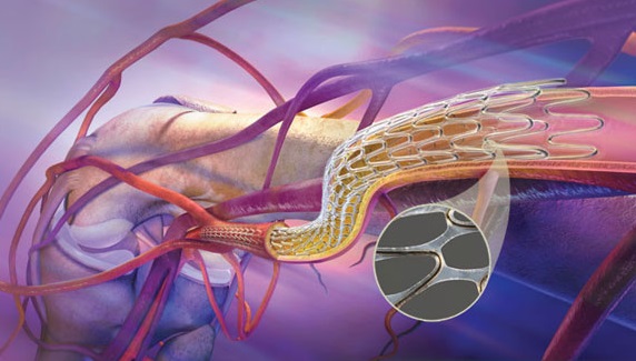 The Gore Tigris Vascular Stent